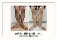 初回限定🌟男性腕or脚セット脱毛👱♂️通常¥10,000→¥5,000‼️(肘上下・手高指)or(膝上下・脚高指)