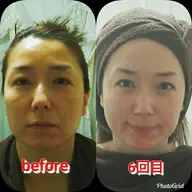 たるみに！超絶リフトアップフェイシャル※お写真掲載OKの方さらに割引🈹