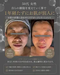 シワに一撃!幹細胞水素トリートメント