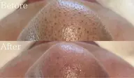 メンズフェイシャルエステ 毛穴開き、よごれ、肌を明るくつやをだしたいかた