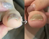 【フット】巻き爪プレート込みジェルネイル