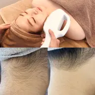 素肌美人を叶えるTHR脱毛🌼超美肌✨顔脱毛+襟足脱毛+ドライヘッドスパ