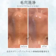 【全顔毛穴洗浄】ハイドラフェイシャル💧
