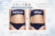 【９０分】ボディ1部位＊脂肪除去スタンプ痩身【２０PUSH】