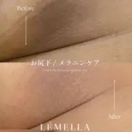 LEMELLAメラニンケア【脇・お尻下・ビキニライン】