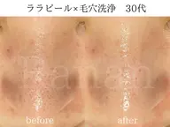 韓国肌管理「LHALAPEEL＋毛穴洗浄」