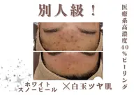 冬までに美白作戦‼ホワイトスノーピール🐿🤍革命的な白さを追求!!!!!自慢のすっぴん肌で黒ずみ毛穴にも◎