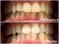 セルフホワイトニング30分