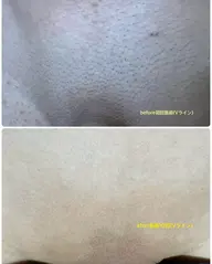 VIO脱毛