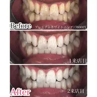 【最速】プレミアムホワイトニング💁‍♀️<合計80分照射2来店>