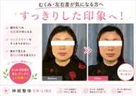 《美容整体》違いがでる小顔ケア✨