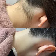 【うなじ美人に💎】うなじ脱毛+保湿付♡形相談もOKで後ろ姿に自信✨
