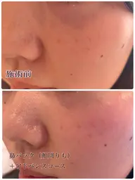 毛穴鼻パック付き！初めての方も安心＊基本のフェイシャルエステコース50分間◎つるつる美肌体験