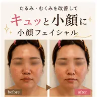 《ミニモ限定》45分*小顔&リフトupフェイシャルパック8,900円→5,900円