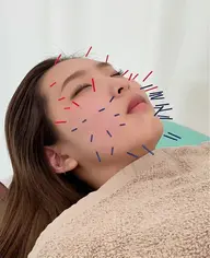 【今話題の美容鍼✨】美容鍼➕パルス電気鍼でむくみゼロのすっきり小顔に⭐️(カウンセリング込)