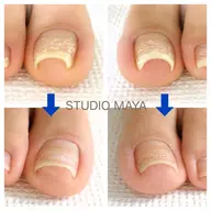 【foot】巻き爪ケア/BSブレイス(巻き爪・陥入爪補正) ※1本 30分