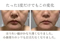 【結果重視】プレミアム幹細胞美容液導入☆しみ、しわ、美白改善コース体験💆♀️✨️