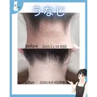【女性限定🎀】Mパーツ脱毛【顔 or うなじ or VIO】