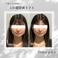 【小顔&たるみ改善】3D超音波リフト🌟お顔の脂肪を撃沈‼︎リフトアップ＆毛穴引き締め,ハリ弾力UP💆🏼‍♀️✨