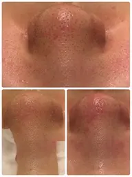 毛穴気になる方はこれ!!毛穴レスケア✨️