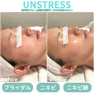 🩵敏感肌OK✨乳酸菌ピーリング/赤み、乾燥、ゆらぎ肌|クリスティーナ“アンストレス”60分