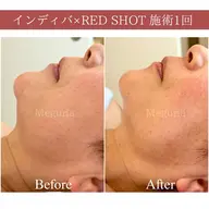 最新小顔🤍REDSHOTでフェイスライン形成✨