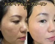 一回で驚き！✨［初回限定］韓国話題の最新美容！水光肌へ✨スピダイヤ＆ハーブピーリング★肌質改善ツヤUP 80分