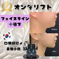 オンダリフト25分|フェイスライン~顎下80kj~140kj