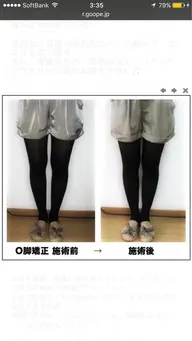骨盤・O脚矯正