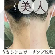 うなじシュガーリング脱毛🍯💓アップスタイルもツルツルもちもちうなじ美人✨ デザイン込み