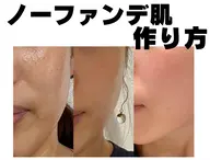 【美肌脱毛】顔脱毛＋鎮静マスク◎にきび/黒ずみ/毛穴/くすみ/ハリ◎　￥13200→3800