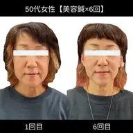 リフトアップ電気美容鍼