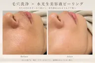 オープン記念!!毛穴洗浄+水光生美容液ピーリング