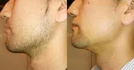 【口コミ割】人気No. 1👑メンズヒゲ脱毛1000円🧔