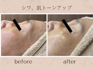 【肌管理ケア】ヒト幹細胞エレクトロポレーション&シェービング 90分