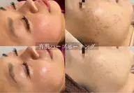 痛み剥離なし☆育肌®︎ハーブピーリング/肌荒れ・乾燥・毛穴・ニキビ・小ジワ・赤み・むくみ等を自らの力で肌質改善!