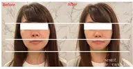 フェイシャル小顔コース45分コース