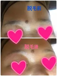 WAX脱毛(顔)