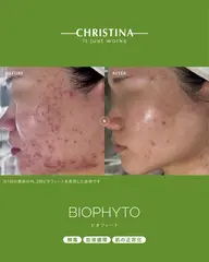 【ご新規様】繰り返すニキビ・肌荒れに◎クリスティーナBIOPHYTOビオフィート