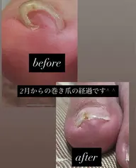 巻き爪ケア2本コース60分