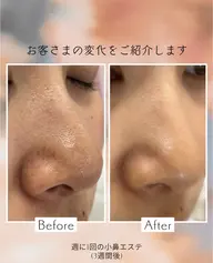 小鼻ツルツルエステ