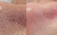 【水光肌】ハーブピーリング✨剥離なし🕛ダウンタイムなし!ニキビ跡、シミ、くすみが気になる方🫧当日メイク🆗💕