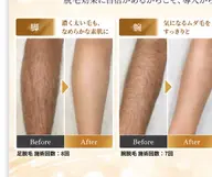 【メンズ全身脱毛】men's全身脱毛(VIOヒップ除く)