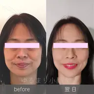 一番人気《たるみ卒業 》Vライン小顔へ！優しいタッチの【頭蓋骨マッサージ×小顔フェイシャル】65分⭐︎半額の6500円