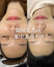 【透明感×毛穴ケア】韓国発・角質ケア+高濃度美容成分を贅沢導入 (トラネキサム酸)+水光パック うるツヤ素肌へ💎✨