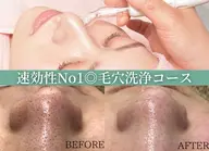 毛穴洗浄コース👃🏻✨イチゴ鼻とはサヨナラ!黒ずみ毛穴/つまり毛穴/開き毛穴でお悩みの方に!
