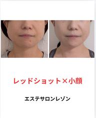【日本上陸】RED SHOT美容液導入トリートメント🌿大人気‼️フェイスラインすっきり小顔ケア初回9800円［京橋駅］