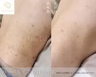 【♥️ミニモ限定価格♥️】背中ハーブピーリング+鎮静ホームパック付き✨🫧66,000円→9,900円