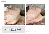 メンズ👑ヒゲ脱毛¥3000