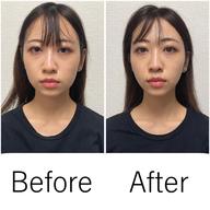 🎉おすすめNo.1🎉【むくみ・エラ・くいしばり特化メニュー】電気美容鍼+フェイスマッサージ+首肩背中マッサージ